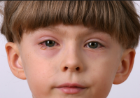 Распространенные детские глазные заболевания